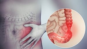 Diet Plan for Irritable Bowel Syndrome (IBS)